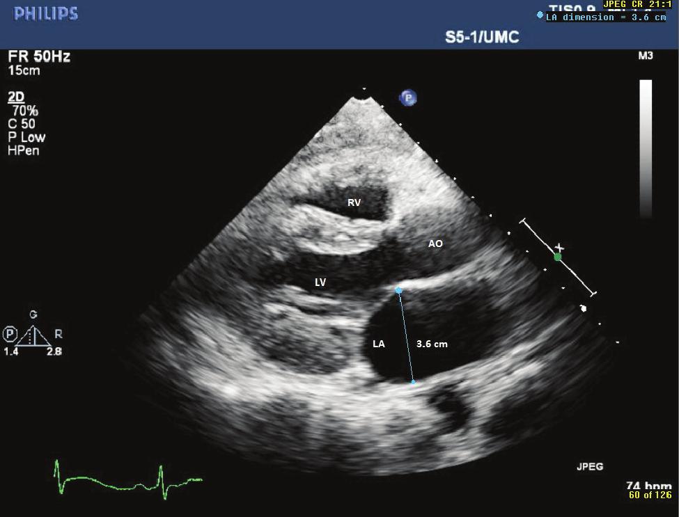 LA size measured by 2-D echocardiography in parasternal long axis view LA size is measured at its maximum diameter at end systole. In this case it is 3.6 cm which is normal.
