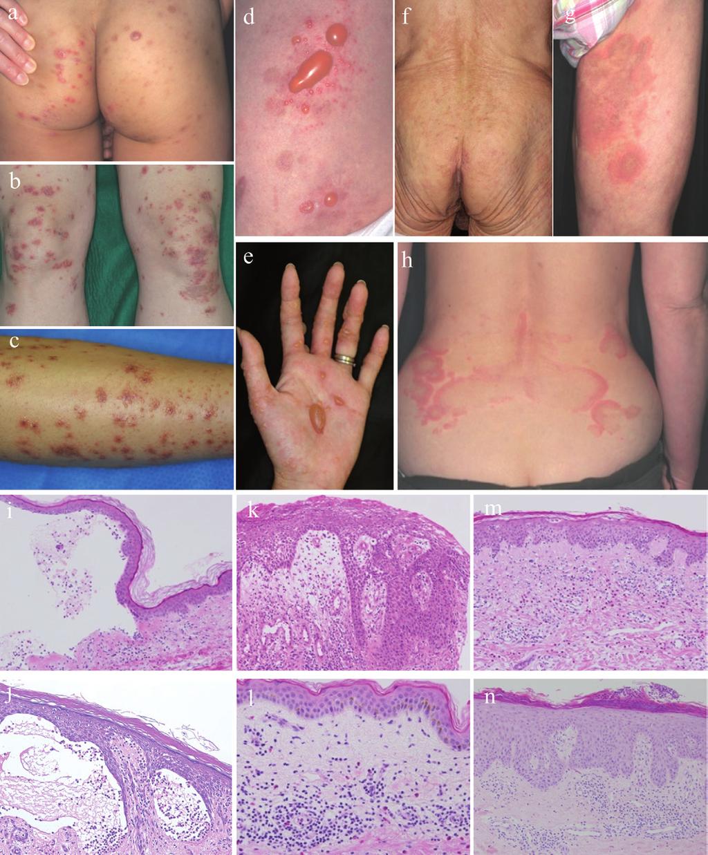 750 T. Hashimoto et al. Fig. 1. Dermatitis herpetiformis-like lesions on (a) the buttock and (b) the knees. (c) Vesicles and eczematous lesions on the shins.