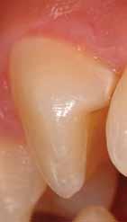 GC Tooth Active caries How often Duration Additional comments Twice a day, after flossing and brushing Until risk of