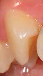 suggestions made on how the patient can reduce their caries risk MODE OF ACTION GC Tooth can repair early damage