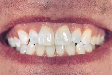 GC Tooth Whitening treatment How often Duration Additional comments prior to starting treatment Twice a day, after flossing and brushing Start 1-2 weeks before whitening procedure Pre-whitening
