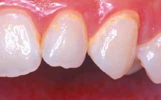 Reversing White Spot Lesions Creating super enamel Immediately after bracket removal Dissolution of enamel mineral through acid challenges is a daily process, which is