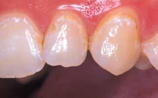 Maximising remineralisation, so that lost mineral is replaced with fluorapatite, means teeth gain additional strength and acid resistance. Dr.H.