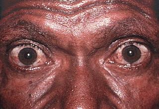 Graves Disease Eye Signs N-no signs or symptoms O only signs (lid