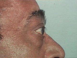 oedema) P proptosis (>22 mm)(hertl s test) E extra ocular muscle