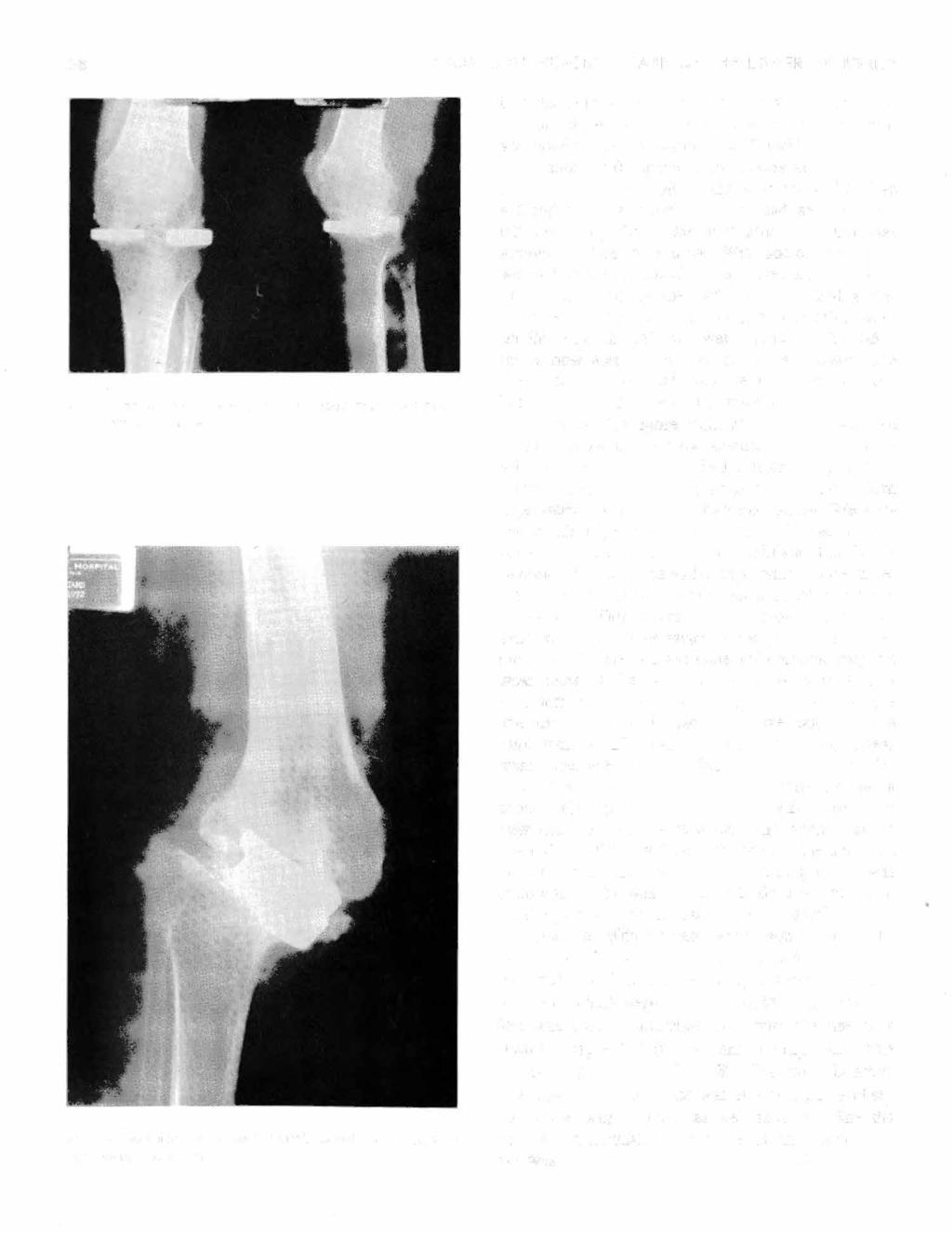 28 THOMPSON: SURGICAL CARE OF THE LOWER EXTREMITY Fig. 8-Mclntosh plateau prosthesis four years postoperatively with good results. Fig. 9-Mclntosh prosthesis which failed in rheumatoid two years postsurgery.