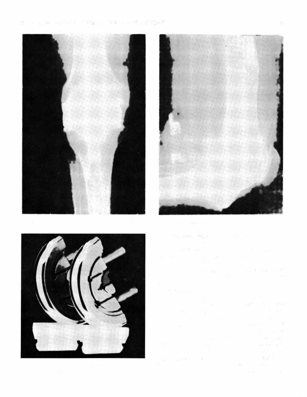 THOMPSON: SURGICAL CARE OF THE LOWER EXTREMITY 29 Fig. IO A, B-Postoperative condition of knee in figure 9, converted to a Walldius hinged prosthesis. Fig. 11-Polycentric knee joint as modified from Gunston by Bryan and Peterson.