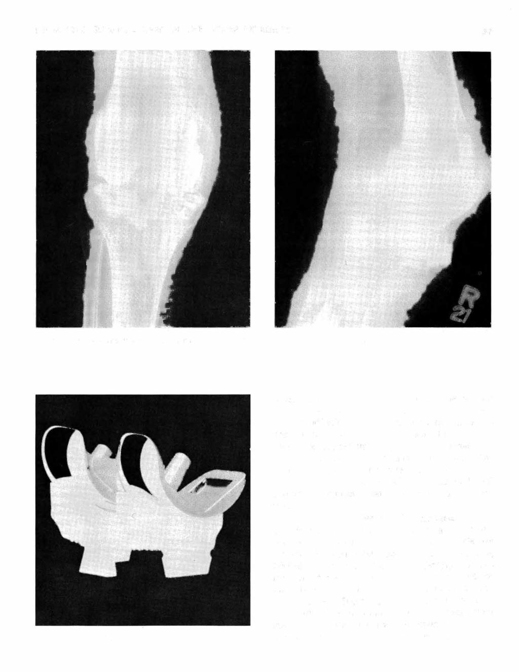 THOMPSON: SURGICAL CARE OF THE LOWER EXTREMITY 31 Fig. 13 A, B-AP and lateral x-ray of knee in figure 12 following polycentric arthroplasty. Fig. 14-Geometric knee joint.