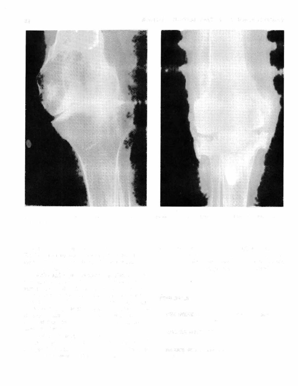 32 THOMPSON: SURGICAL CARE OF THE LOWER EXTREMITY Fig. 15 A, B-Pre- and postoperative x-rays of knee with severe osteoporosis where geometric knee joint was used for arthroplasty.