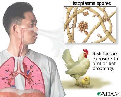 Histoplasmosis Symptoms & Diagnosis Most people with histoplasmosis do not have any symptoms