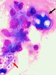 Coccidioidomycosis Symptoms & Diagnosis Coccidioides immitis Southwest US, Central America, South America Infection occurs mainly in