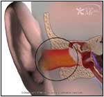 Sinuses aspergillosis removed surgically Ear canal