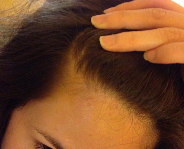 GENERAL OVERVIEW OF TYPES OF HAIR LOSS AND ALOPECIA TELOGEN EFFLUVIUM Telogen effluvium is a form of diffuse hair loss that occurs during the telogen or resting phase of the hair growth cycle.