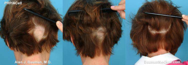 ALOPECIA AREATA 'Alopecia is a general term for hair loss - from mild and temporary shedding to profuse and permanent loss.