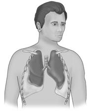 Pleural Effusion Caused by irritation, infection, cancer, or trauma (bruised lung) Collection