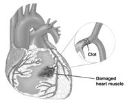 Coronary Artery Disease (CAD) Coronary artery disease involves decreased blood flow to the heart and the potential for ischemia. Chest pain results from ischemia.