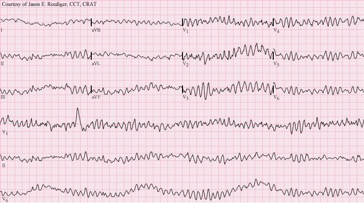 Ventricular Fibrillation Rapid and irregular No normal