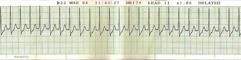 Supraventricular Tachycardia Rapid (usually 150-250 bpm) and regular P