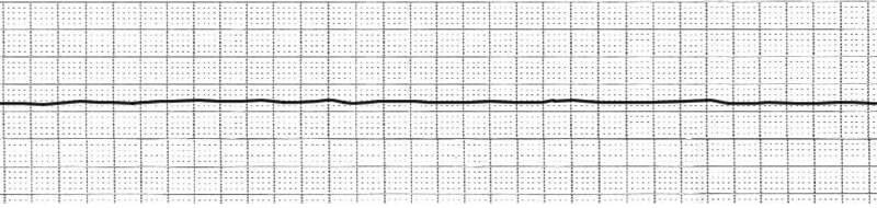 Asystole Is it really asystole? Check lead and cable connections. Is everything turned on?
