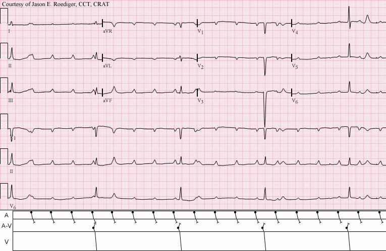Junctional Escape Slow and relatively regular No P waves Narrow QRS Arises from