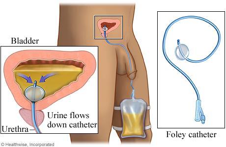 Catheters In medicine, a catheter is a tube that can be inserted into a body cavity, duct, or vessel.