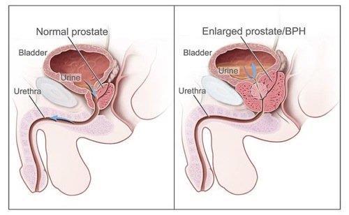 Prostate Enlargement While the prostate* is considered part of the reproductive system, as this organ grows in size, it can affect urine output in men.