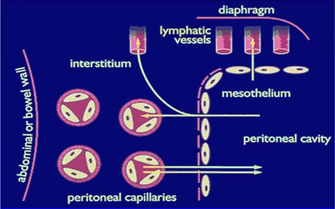 Peritoneal Dialysis (PD) Sterile dialysate introduced into peritoneal cavity through a catheter Dialysate exchanged at intervals Particle removal by diffusion Fluid removal by ultrafiltration