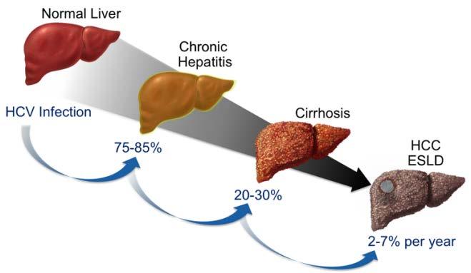 Progression to cirrhosis happens over decades treatment 4-6 million persons in the US