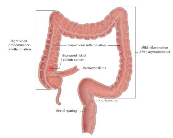 The inflammatory bowel disease