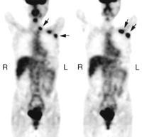 Use of 18 F-FDG in cancer diagnosis FDG PET images of patient with recurrent breast cancer involving left axillary and supraclavicular lymph nodes (arrows).