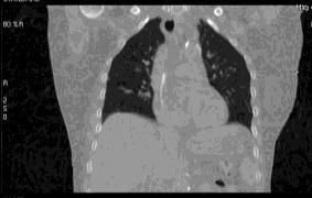 CT of thorax