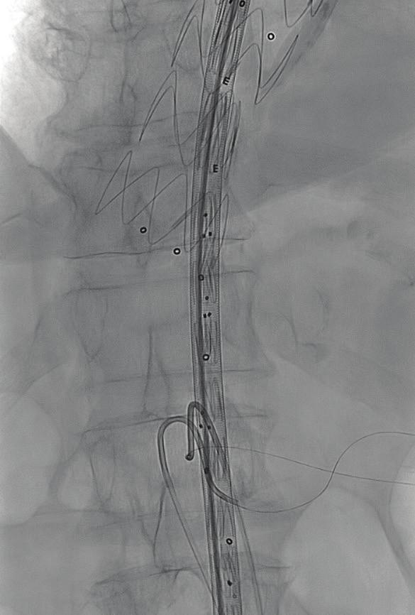 In order to decrease the risk of spinal cord ischemia, we decided to offer this patient a staged endovascular treatment of the aneurysm.