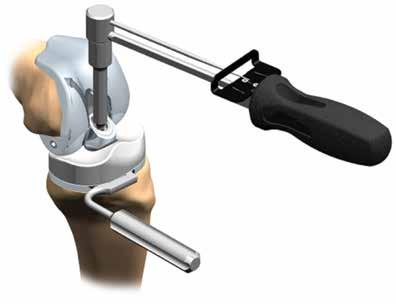 Remove the Post Bolt turning counterclockwise (Figure 3) while applying a counter torque with the Tibial Stabilizing Tool.