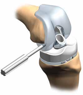 The first method involves removal from one side of the femoral due to limited accessibility to the opposite side.