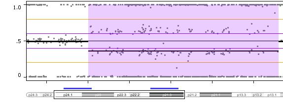 SNP Genotyping SNP haplotype analysis of the patient and her parents within genomic regions associated with copy number variations: Duplications arose on