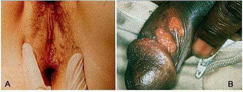 The primary episode of either genital or oral herpes often causes painful blisters and flulike symptoms [Table 1].
