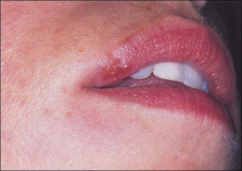 Oral herpes lesions often appear around the mouth at times of illness, after sun or wind exposure, during menstruation, or with emotional stress.