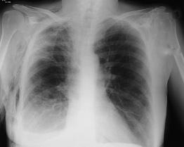 CASE PRESENTATION This answer is incorrect. While there are no focal lung field abnormalities, the chest radiograph is not completely normal.