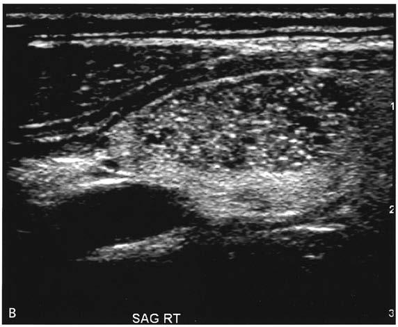 Identify nodules with higher a priori risk of cancer Solid, hypoechoic Neck ultrasound Fine, stippled