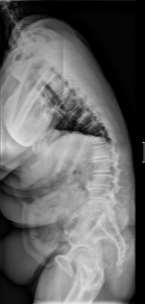2. Post-traumatic kyphosis at T12 in 68 year old gentleman.
