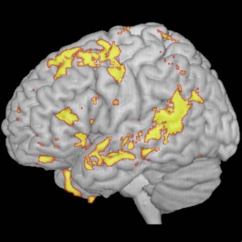 Whole-brain analysis revealed grey matter gains in frontotemporal areas