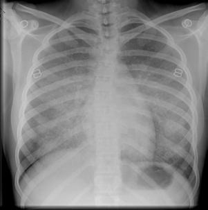2 Different Children with Pulmonary