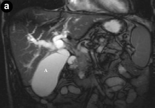 duct insertion site, but the pancreatic duct was not significantly dilated.