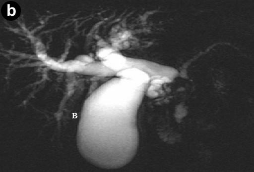 MRCP showed a small non enhancing area of low T1 signal within the pancreatic head surrounding the intra-pancreatic common bile duct extending to the ampulla of uncertain significance.
