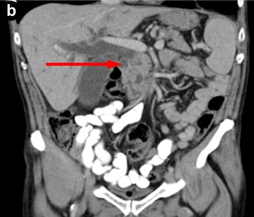 At his initial presentation the history, clinical and radiological findings were representative of acute pancreatitis and in this case groove pancreatitis due to its location, but over the following