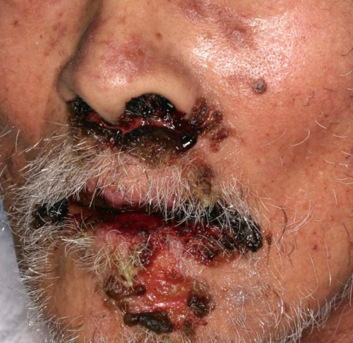Paraneoplastic Pemphigus Hallmark: intractable stomatitis earliest presenting sign Other features include polymorphic cutaneous eruption, pseudomembranous conjunctivitis