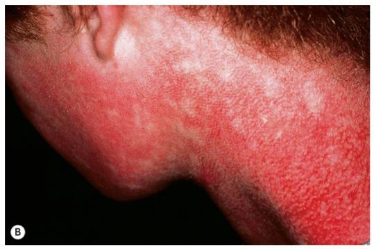 Kindler Syndrome Autosomal recessive genodermatosis Characterized by: skin fragility and bullae