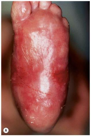 poikiloderma cutaneous atrophy severe peridontal disease Mutation in FERMT1 (KIND1) encodes for