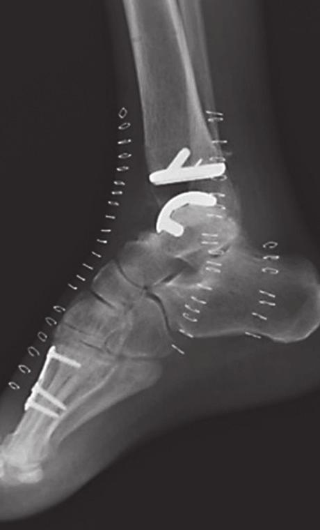 ankle implants!