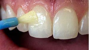 Systemic and Topical Fluoride Systemic fluorides are those that are ingested and become incorporated into forming tooth structures.